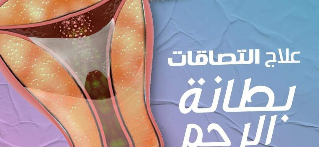 التصاقات الرحم