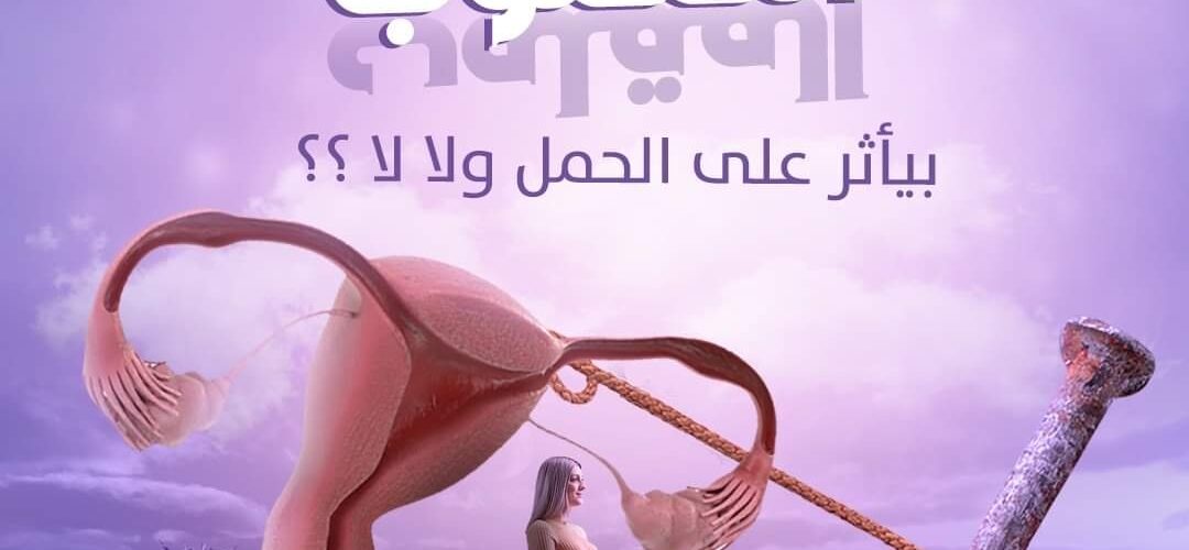 الرحم المقلوب