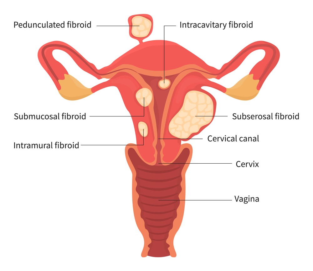 اورام الرحم الليفية